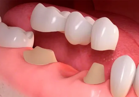Фото для Протезирование зубов: пластмассовая коронка