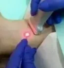Лазерная деструкция узлов и кист щитовидной железы
