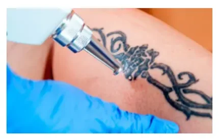 Лазерное удаление татуировок и татуажа на аппарате Q-switched ND: YAG