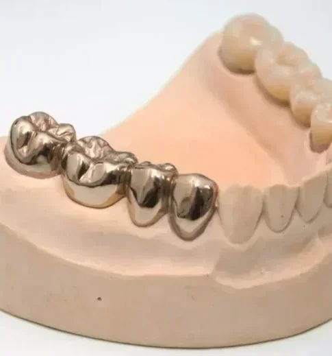 Несъемное протезирование: Восстановление зуба постоянной металлической коронкой