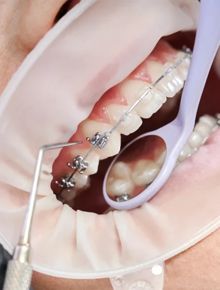 Фото для Установка брекет - систем Damon Q