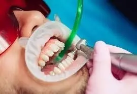 Профессиональная гигиена полости рта и зубов для взрослых
