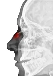 Рентгенография костей лицевого скелета (костей носа в боковой проекции)