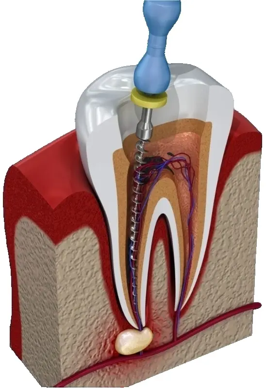 Лечение периодонтита постоянного зуба