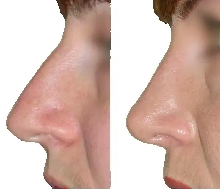 Пластика перфораций носовой перегородки (1 этап)
