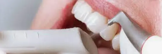 Профессиональная гигиена полости рта и зубов методом Air Flow («Эйр Флоу»)