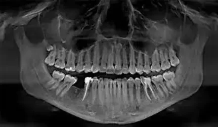 Ортопантомография или панорамный снимок зубов.
