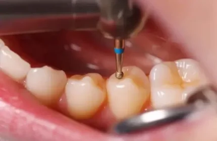 Лечение среднего кариеса зубов профессиональными стоматологами.