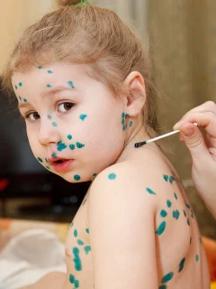 Анализ на ветряную оспу IgG и ветряную оспу IgM