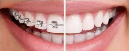 Фото для Ортодонтическая коррекция с применением брекет-систем