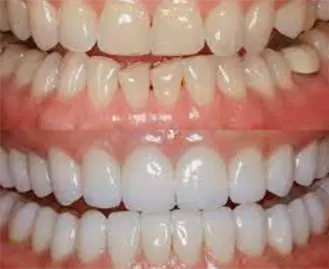 Художественная реставрация зубов для взрослых профессиональным стоматологом.