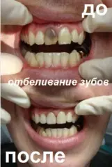 Отбеливание 1-го зуба от 1800 рублей